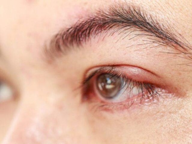 Kurang bersih saat hapus riasan mata dapat sebabkan penyakit hordeolum