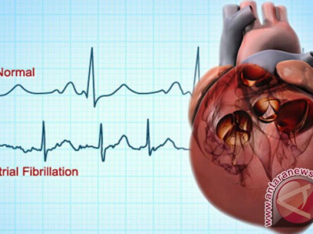 Dokter: Skrining untuk deteksi risiko kelainan jantung saat olahraga 