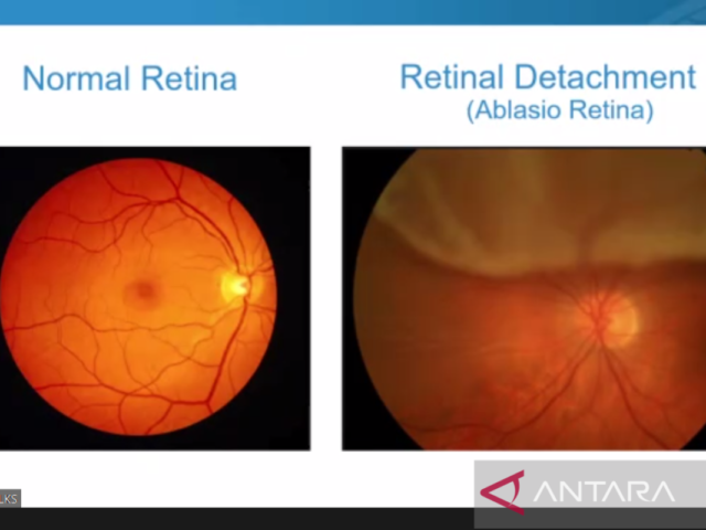Usia 40 tahun ke atas rentan terkena ablasio retina